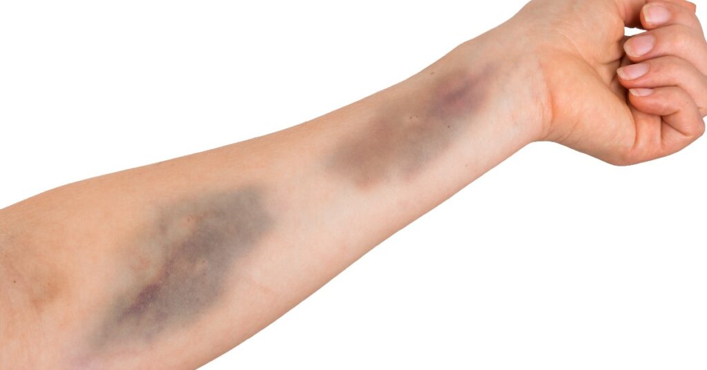 Modrice . simptomi nedostatka vitamina c - vegatonics nutricionizam