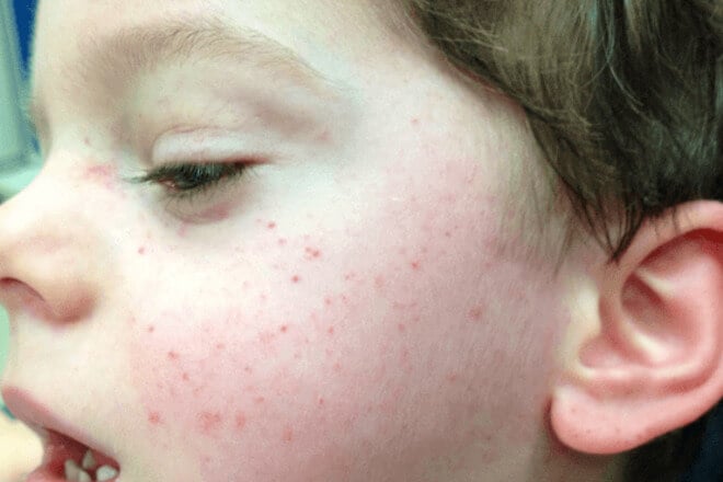Petehije na licu - simptomi nedostatka vitamina c - vegatonics nutricionizam