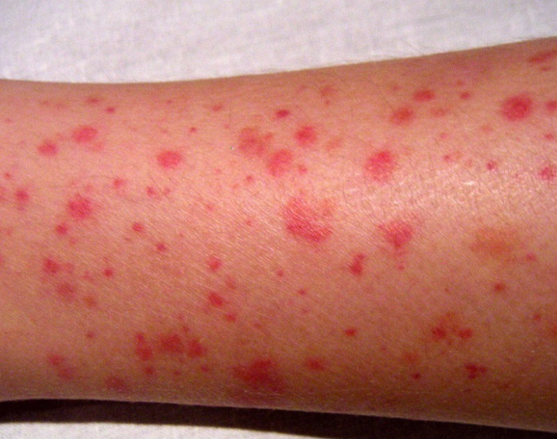 Purpura - simptomi nedostatka vitamina C - vegatonics nutricionizam