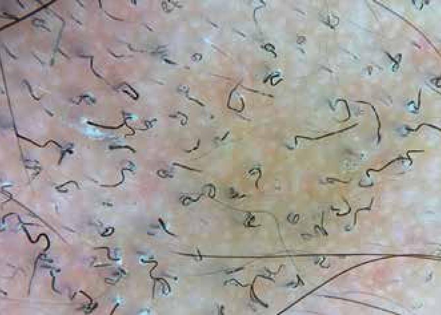 Dlačice u obliku vadičepa - simptomi nedostatka vitamina c - vegatonics nutricionizam